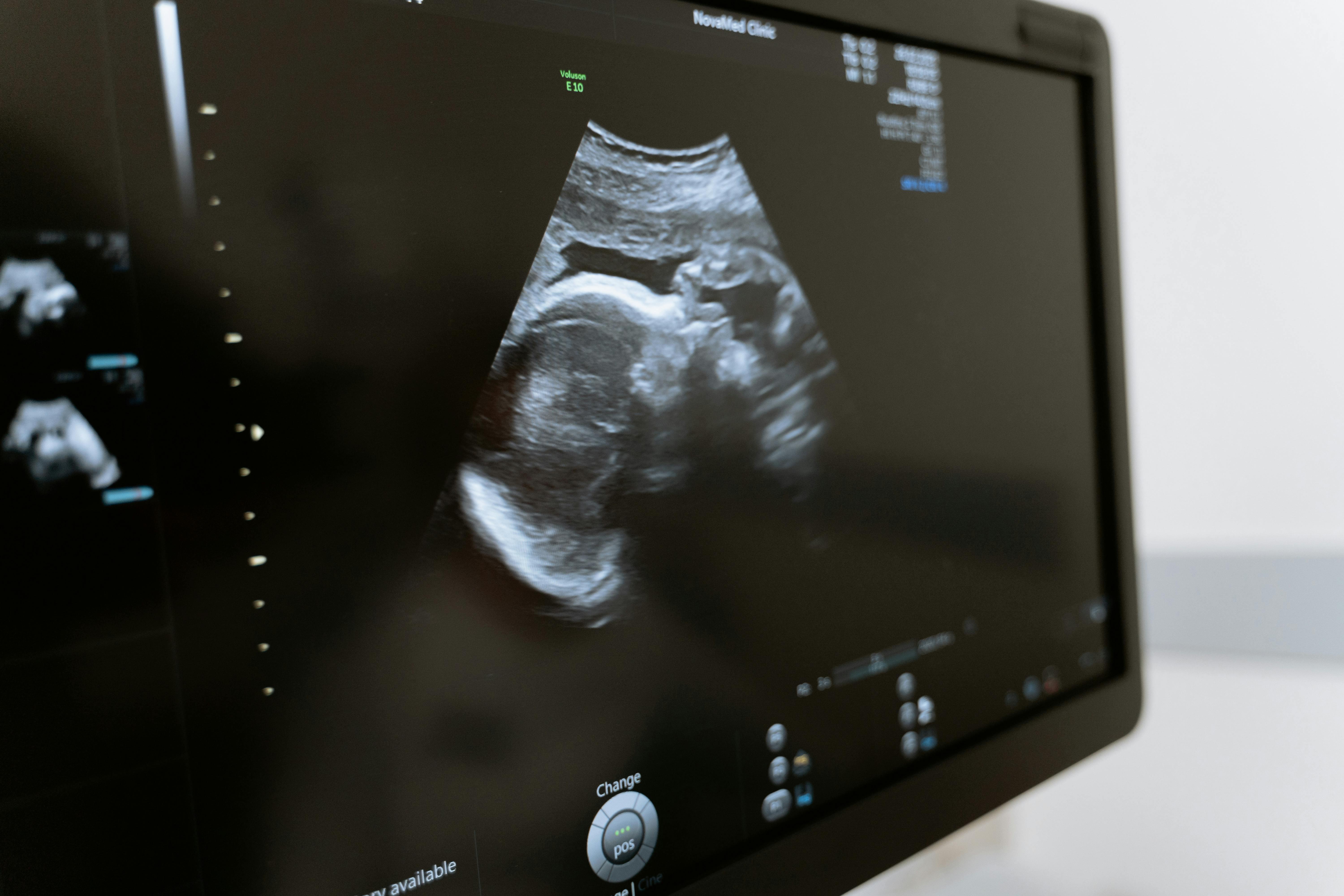 Ultrasound Imaging